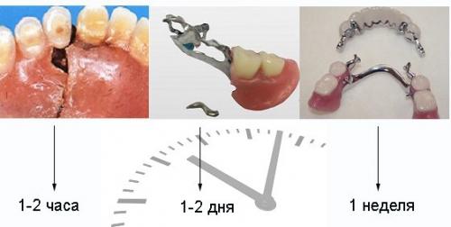 Ремонт зубных протезов в домашних условиях. Срочный ремонт зубных протезов 09 Ремонт зубных протезов в домашних условиях. Срочный ремонт зубных протезов 09